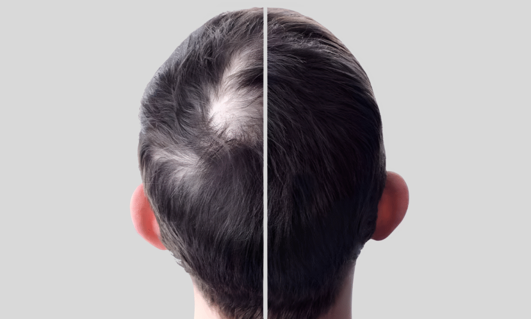 টাকে চুল গজানোর নতুন ওষুধ: ৮ সপ্তাহেই ঘন চুলের আশ্বাস